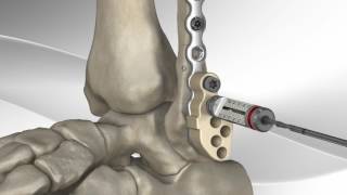 Enkel fractuur operatieve behandeling fibula [upl. by Edrock8]