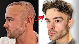 6 Month Hair Transplant Journey Full Recovery [upl. by Lrig]