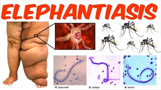 Lymphatic Filariasis  Elephantiasis [upl. by Dimitry112]