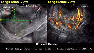 Cervix Ultrasound Reporting  Nabothian Cysts Polyp Fibroid Cervical Incompetence Cancer USG [upl. by Blumenthal]