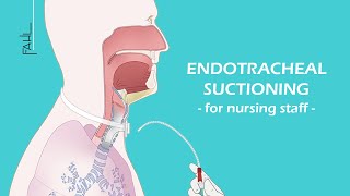 Endotracheal suctioning ETS for nursing staff  Animation  Fahl MedizintechnikVertrieb GmbH [upl. by Tallou505]