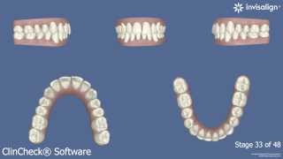 Mordida profunda y maloclusión solucionados con Invisalign [upl. by Erida]