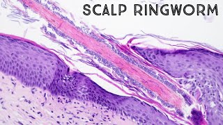 Ringworm under microscope hair follicle fungus in scalp aka tinea capitis pathology dermpath [upl. by Hurst620]