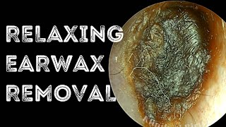 Relaxing Deep Impacted Earwax Removal [upl. by Ongun595]