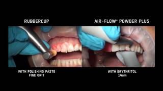 AIRFLOW® VS Rubber cups [upl. by Rugg]