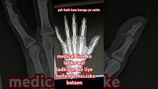 hand ap view fracture youtuber youtubeshorts youtubevideo [upl. by Nura918]