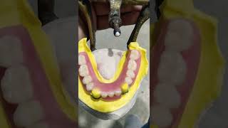 Lower Removable Partial Denture By Haider 😁😁😁rpddentalprocedure partialdenture [upl. by Leora]