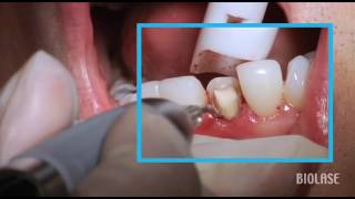 Laser Epic x  GingivectomyTroughing Biolase [upl. by Ahsemik426]