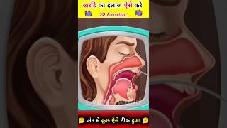 Snoring Treatment  खर्राटे का इलाज कैसे करे  shorts viral youtubeshorts [upl. by Hewie]