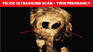 Pelvic Ultrasound Scan  Twin Pregnancy  Dr Kunal Rathod [upl. by Hervey]