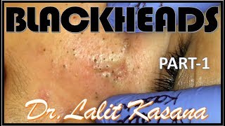 BLACKHEAD REMOVAL PART 1 BY DRLALIT KASANA [upl. by Emmalee]