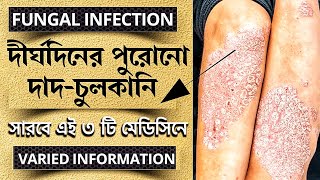 Fungal infection complete treatmentFungal infection treatmentFungal infection in bangla [upl. by Addy]