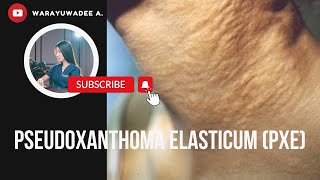 ผิวเป็นตุ่มคล้ายหนังไก่ Pseudoxanthoma elasticum PXE [upl. by Islaen]