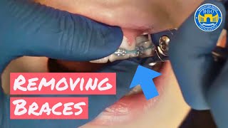 Process of Removing Braces [upl. by Dde]