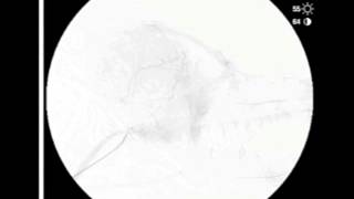 Nasal Embolization [upl. by Neale]