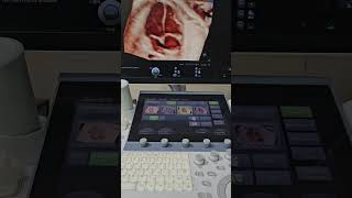 Fetal Echo  4 Chamber View  4D Ultrasound [upl. by Eelesor]