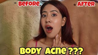 How I got rid of Body Acne in 1 month [upl. by Zuliram]