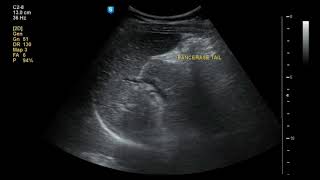 Gallstone Pancreatitis ultrasound [upl. by Graces]