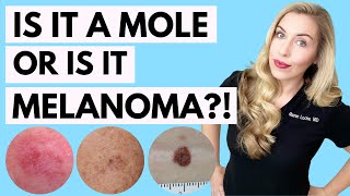 Is It A Mole or Melanoma This Might Save Your Life  Dermatologist Tips [upl. by Sucramrej]