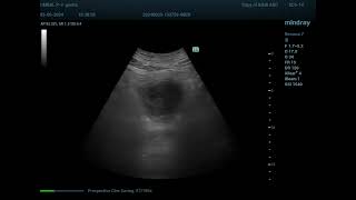 Sigmoid cancer 18 [upl. by Weisman]