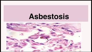 Asbestosis [upl. by Elsworth]