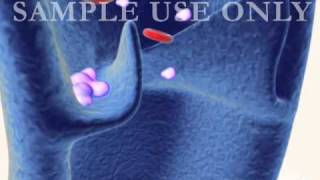 Deep Vein Venous Thrombosis DVT and Pulmonary Embolism PE  3D Medical Animation [upl. by Aneed930]