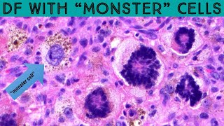 Dermatofibroma with quotmonster cellsquot scary name benign tumor dermpath pathology dermatology [upl. by Neemsaj]