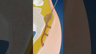 Silacsinus laser ablation of pilonidal cyst  procedure surgerymedical surgeon procedure mbbs [upl. by Abbi641]