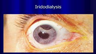 Uveal tract and Glucoma spot diagnosis slides [upl. by Leeban]