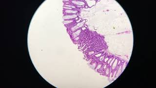 Sessile serrated lesion with serated dysplasia [upl. by Mcginnis543]