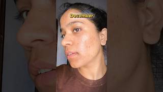 Tretinoin cream before and after  January to December Transformation  tretinoin acne face  🤫 [upl. by Claudell]