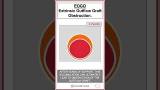 Heartmate LVAD EOGO Extrinsic Outflow Graft Obstruction shorts lvad [upl. by Bagger]