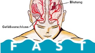 AVC  Schlaganfall einfach erklärt  Apoplex Ursachen Risikofaktoren und Therapie [upl. by Cobbie642]