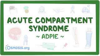 Compartment Syndrome Nursing Process [upl. by Ominoreg656]