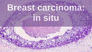 Breast Carcinoma in situ  Pathology mini tutorial [upl. by Hertberg925]