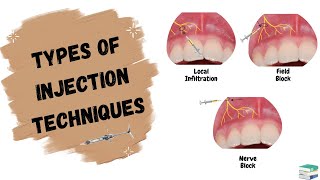 Types of Injections used in Dentistry  Local Anesthesia [upl. by Pepito]