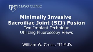 Minimally Invasive Sacroiliac Joint SIJ Fusion Twoimplant technique utilizing Fluoroscopy views [upl. by Ormond]