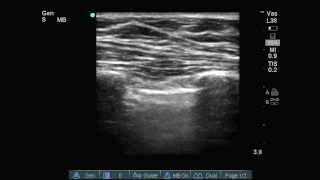 Lung ultrasound quotLung Pointquot [upl. by Annawal]