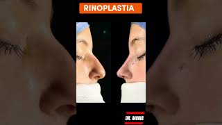 Rinoplastia Ultrasónica en Argentina [upl. by Jacobsen]