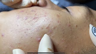 Blackheads amp Whiteheads Removal New 2024  Acne Treatment With Bo Nguyễn Spa 018 [upl. by Llertnahs]