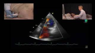 Jet Direction and the Mechanism of Mitral Regurgitation [upl. by Abehsat]