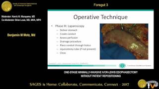 Onestage minimallyinvasive IvorLewis esophagectomy without patient repositioning [upl. by Shurwood]