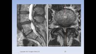 Lumbar Spinal Stenosis Cauda Equina Syndrome Sciatica amp Disc Herniation An Advanced Lecture [upl. by Bobby392]