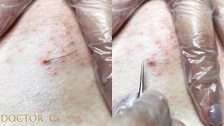 cleaning infected ingrown hair [upl. by Namlas]