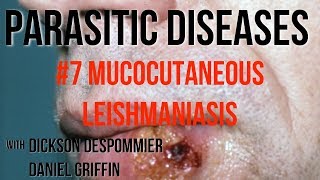 Parasitic Diseases Lectures 7 Mucocutaneous Leishmaniasis [upl. by Loesceke]