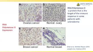 Scleroderma and Cancer What are the Connections Laura K Hummers MD ScM [upl. by Nadab275]