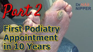 Monster Callus  First Podiatry Appointment in 10 Years Part 2 Callus Tuesday 2023 [upl. by Elatnahc95]