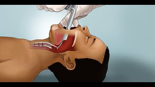 Pediatric Endotracheal Intubation by J Nagler et al  OPENPediatrics [upl. by Ragan]