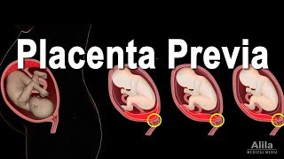 Low Lying Placenta  Placenta Previa Animation [upl. by Rhyner]