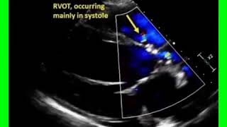 Supracristal Ventricular Septal Defect [upl. by Rednasela]